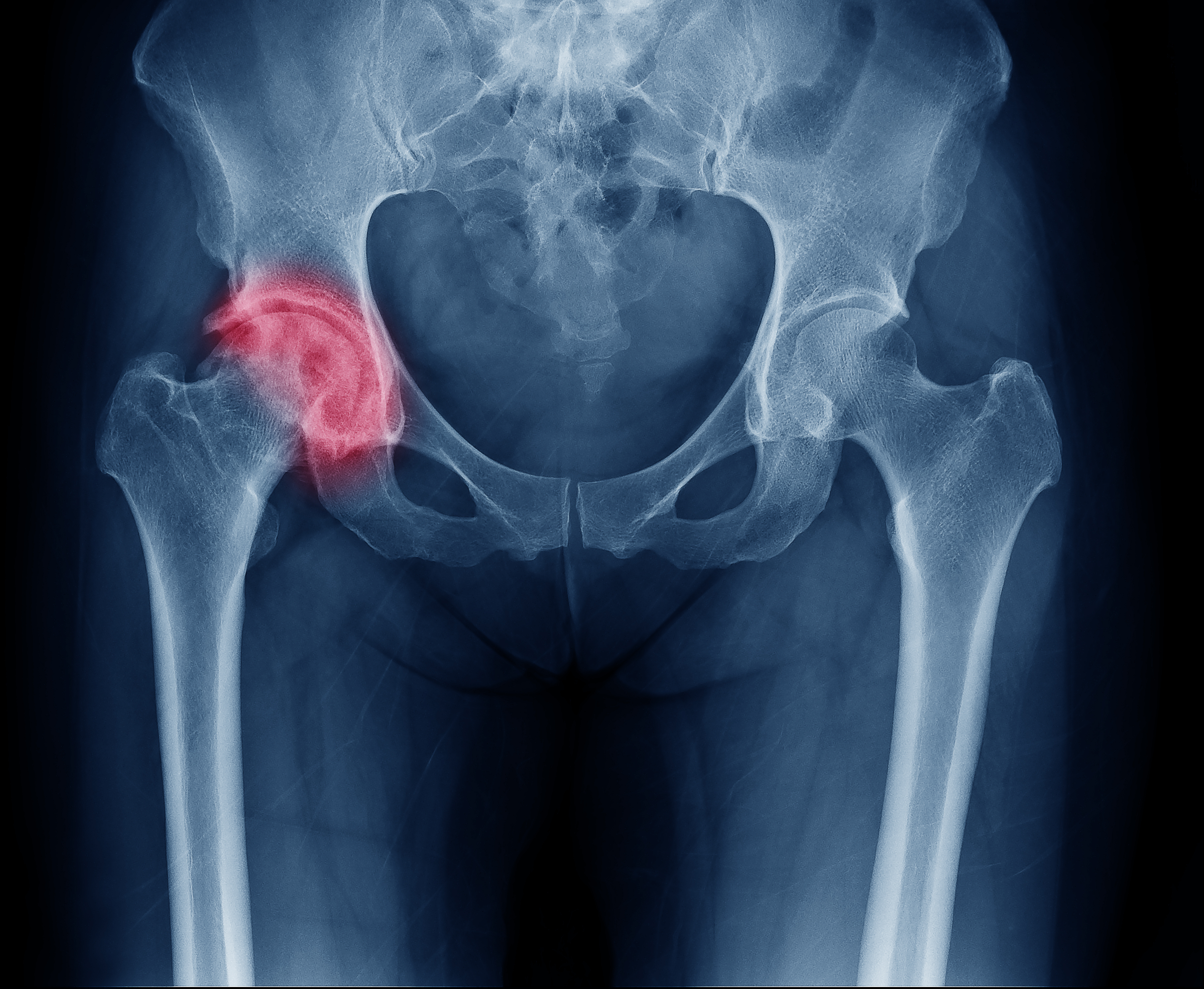 How Long To Walk After Hip Fracture Surgery